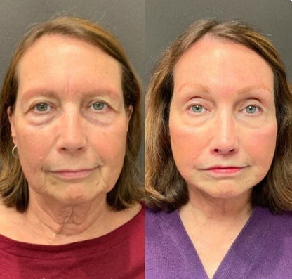 Rejuvenecedor - Palp Lifting Invisible